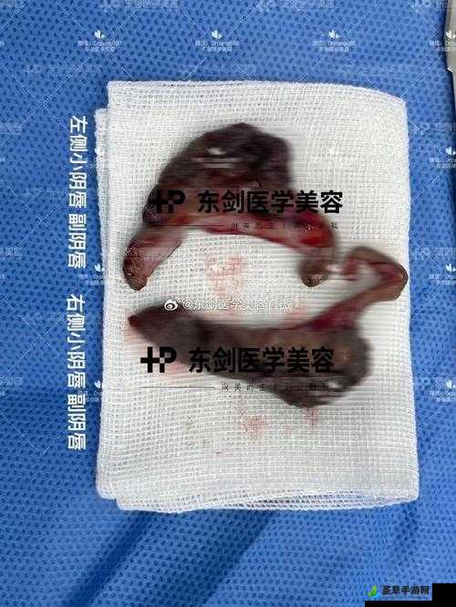 小阴天唇肥大整形有必要吗：到底应不应该进行此类整形手术